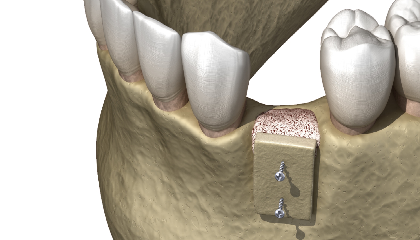 implantologia dentale